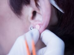 Semeadura de ouvido: a tendência de bem-estar que promete reduzir o estresse, a fadiga e a dor