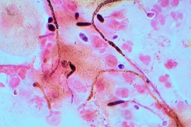 Candida_Gram_stain.jpeg